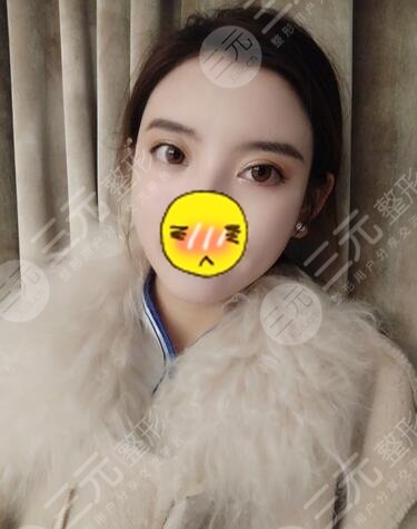 苏州磨骨案例:术后122天