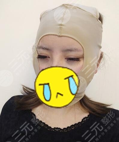 苏州磨骨案例:术后当天