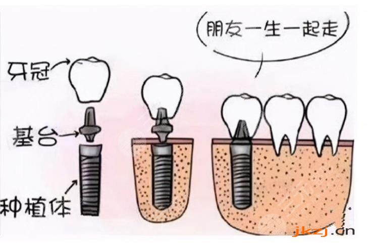 牙齿种植相关知识科普