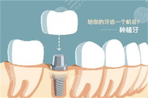 宁波拜博口腔医院种植牙怎么样