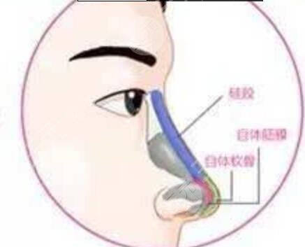 沈阳百嘉丽整形医院隆鼻案例