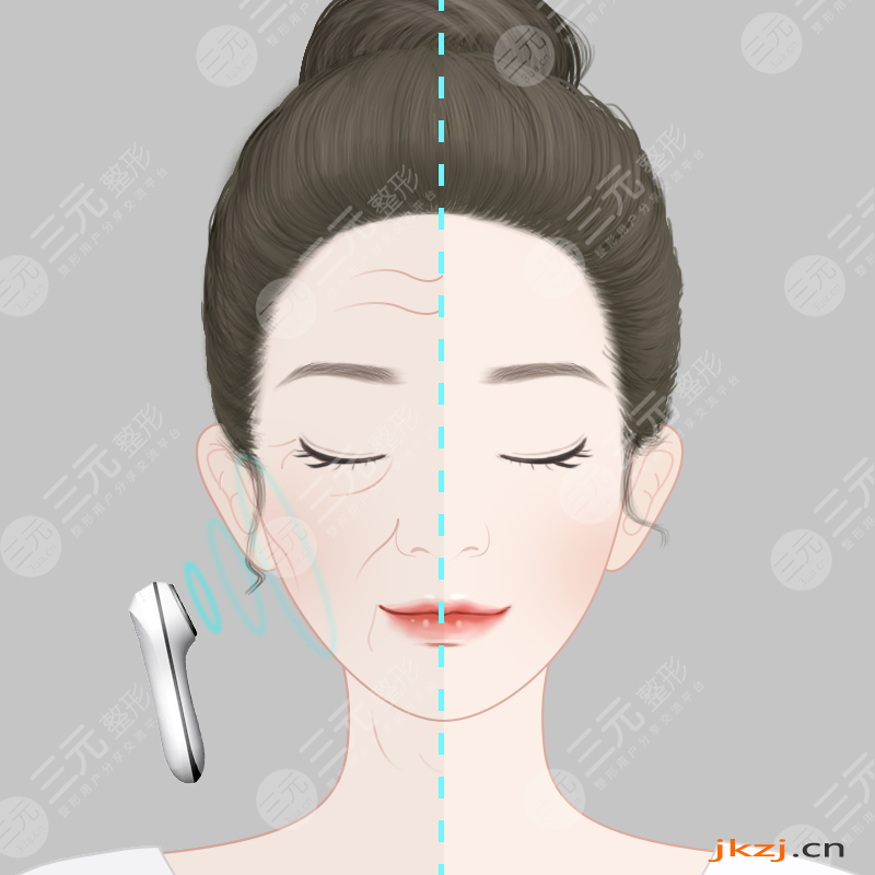 热玛吉真人体验果反馈