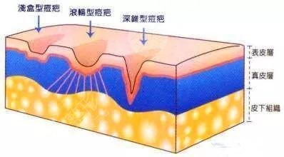 激光祛痘印有副作用吗?