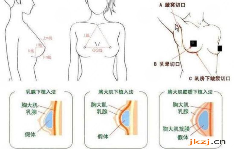 假体隆胸的功如何?