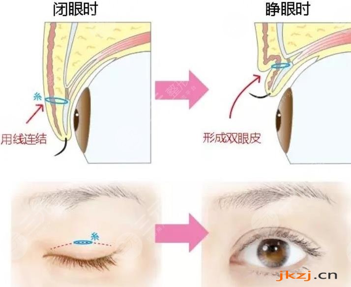 双眼皮整形
