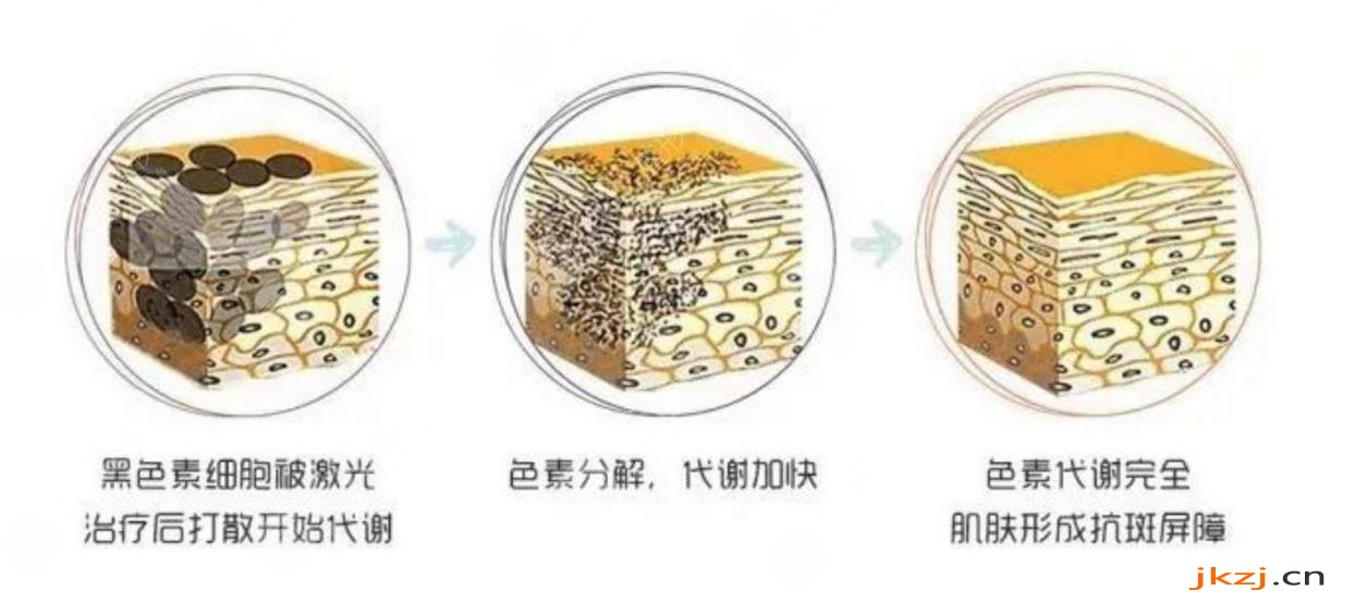 激光去雀斑的果可以维持多久?
