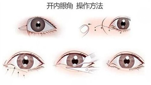 南昌佳美美容医院眼部手术后10天