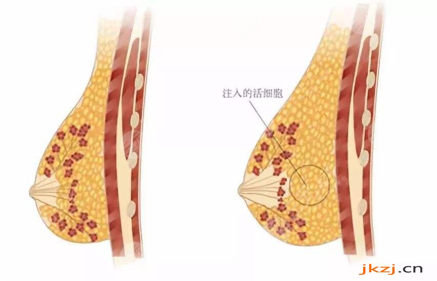 哈尔滨艺星医疗美容医院科普脂肪隆胸